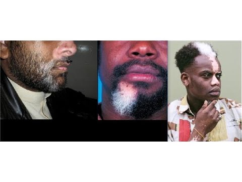 Numbers 12:10 — Leporsy according to the Bible